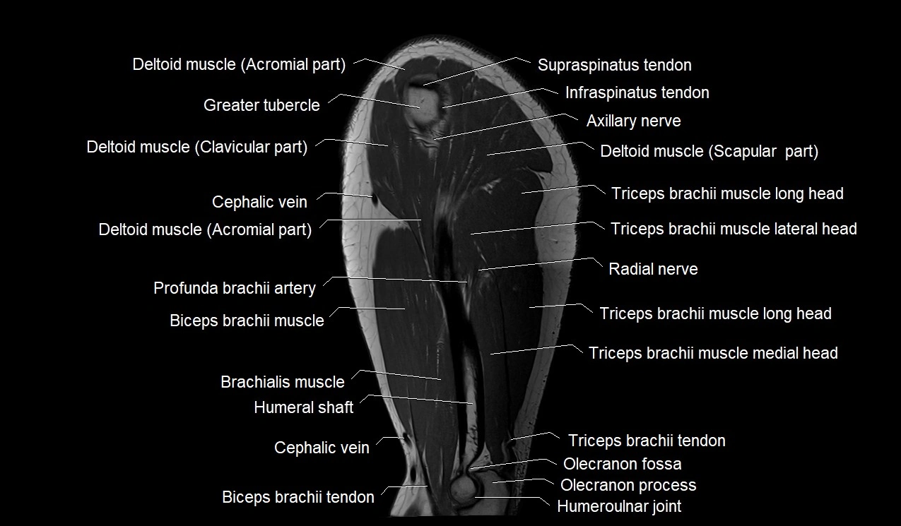 Upper arm (humerus ) saittal cross sectional anatomy 3T image 13.webp